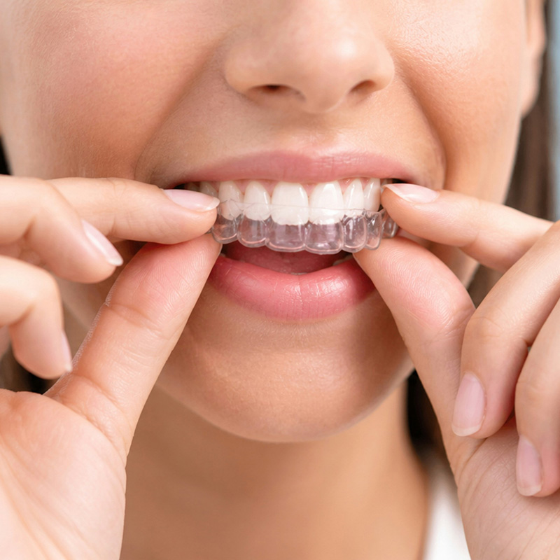 Clear Aligner