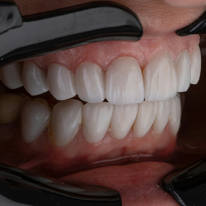 Teeth Whitening