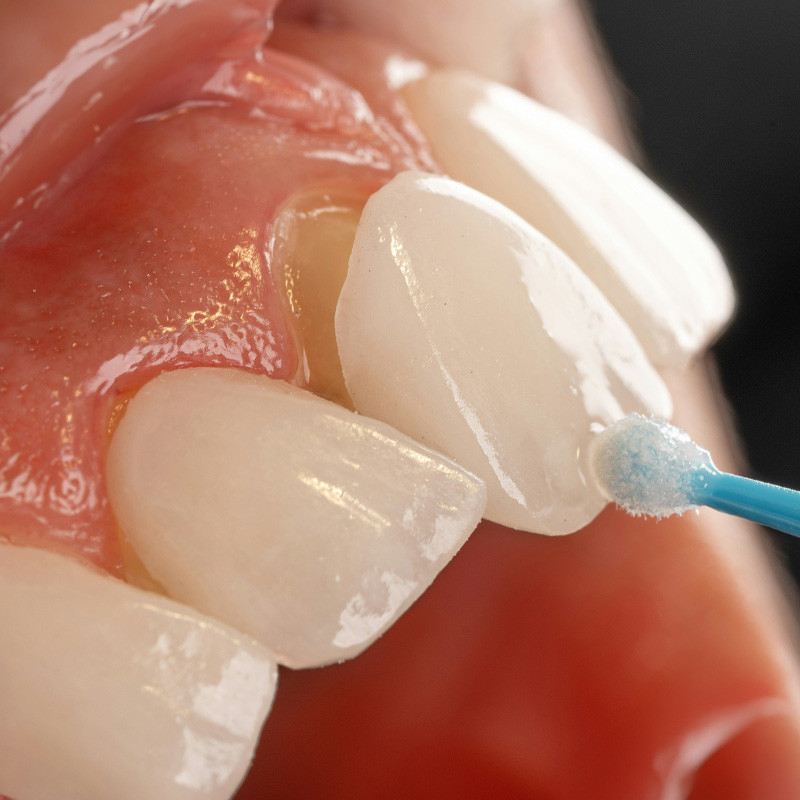 Dental Veneers